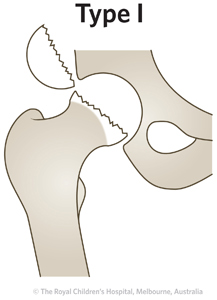 ED Section 1 FEMORAL NECK FRACTURE Type 1